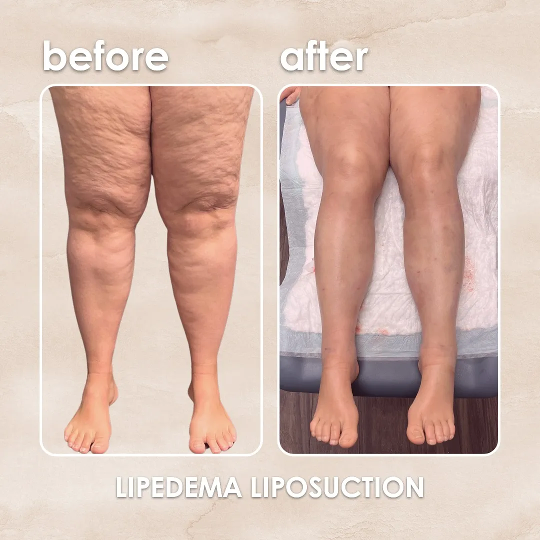 Lipedema before-and-after comparison.