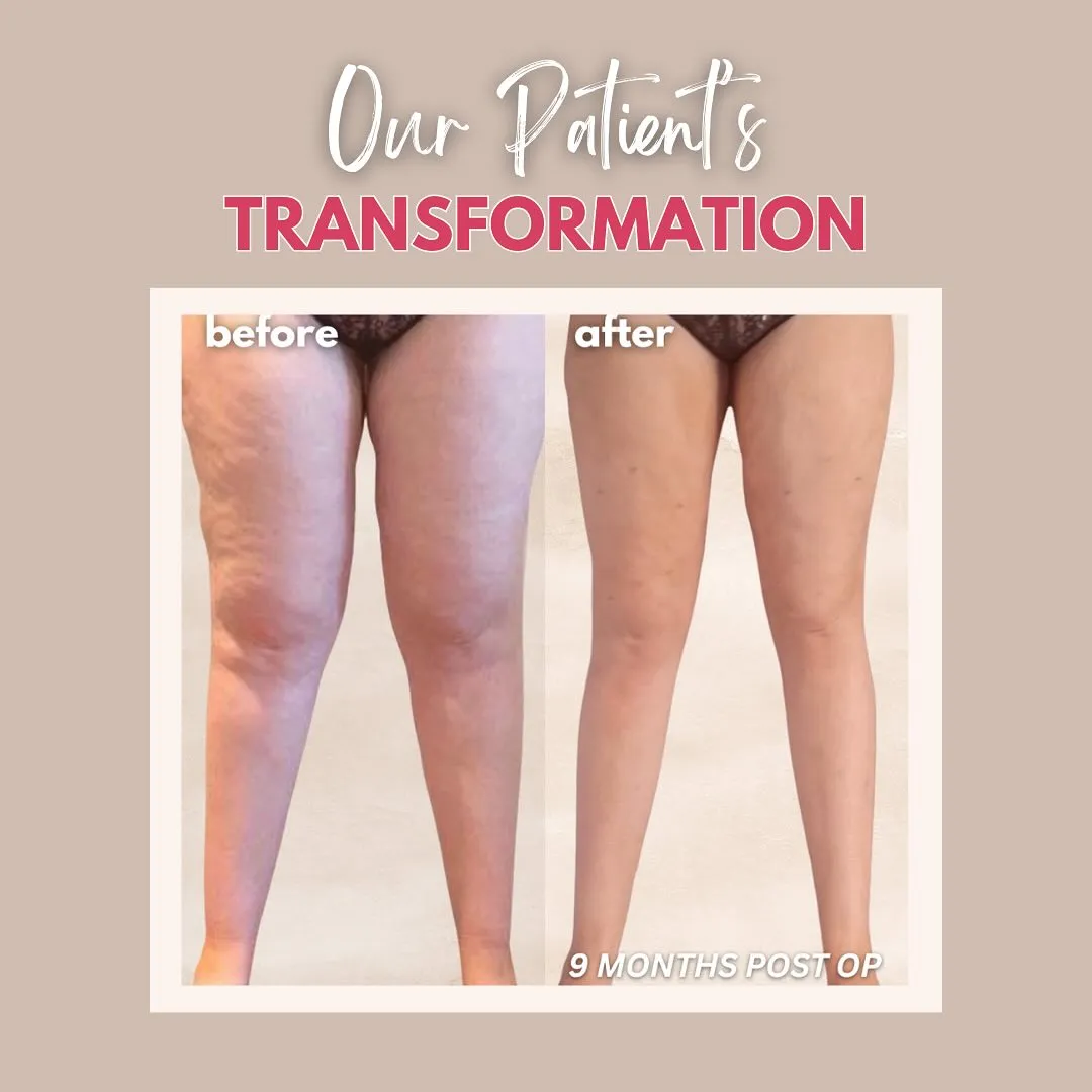 Lipedema before-and-after comparison.