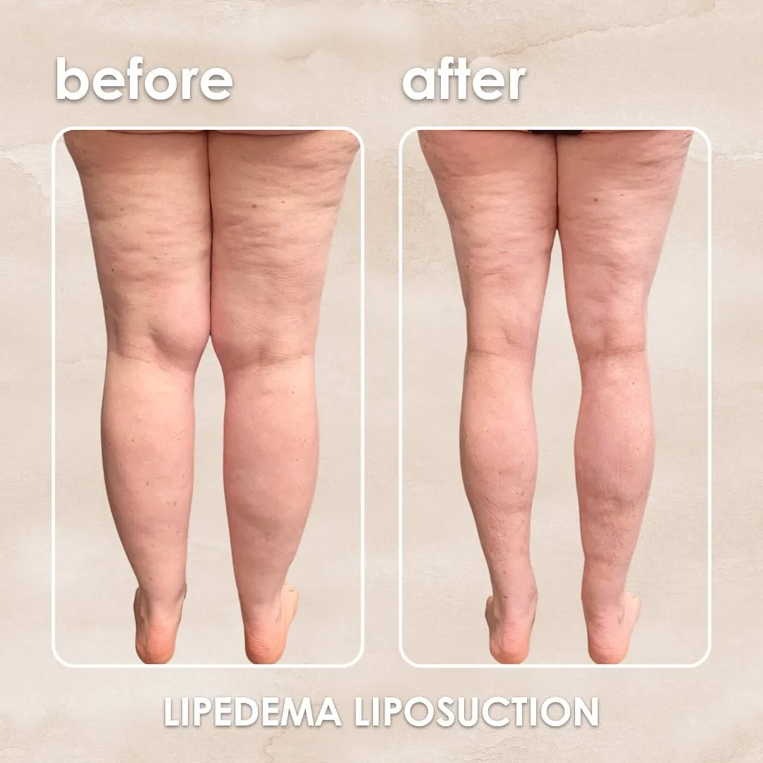 Lipedema before-and-after comparison.