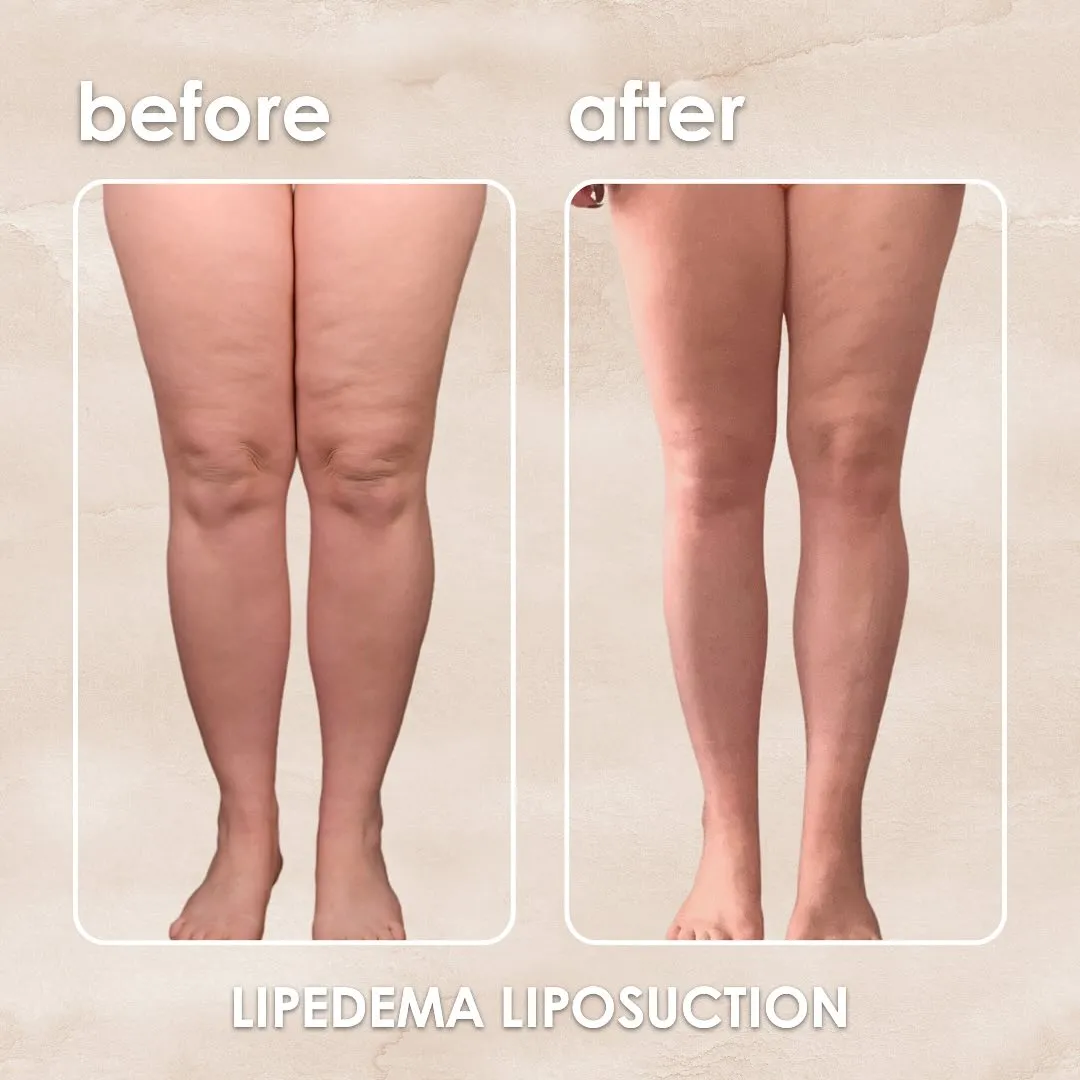 Lipedema before-and-after comparison.