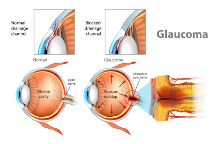 Regular Glaucoma Care