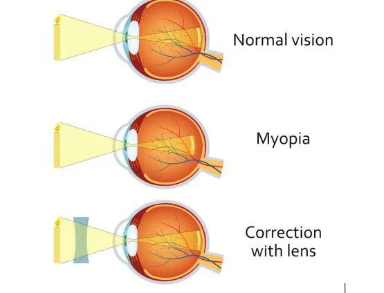 Myopia Management Humble