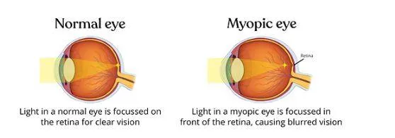 Myopia Management Willis