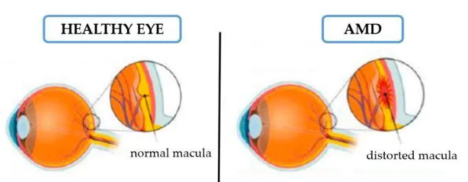 Macular Degeneration Care