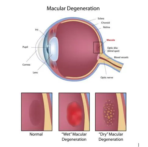 Macular Degeneration