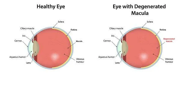 Macular Degeneration