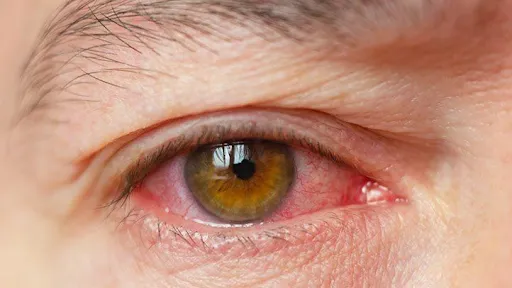 dry eye symptoms