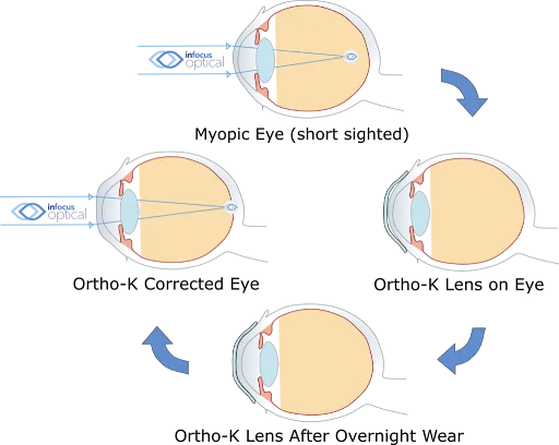 ortho-k lenses