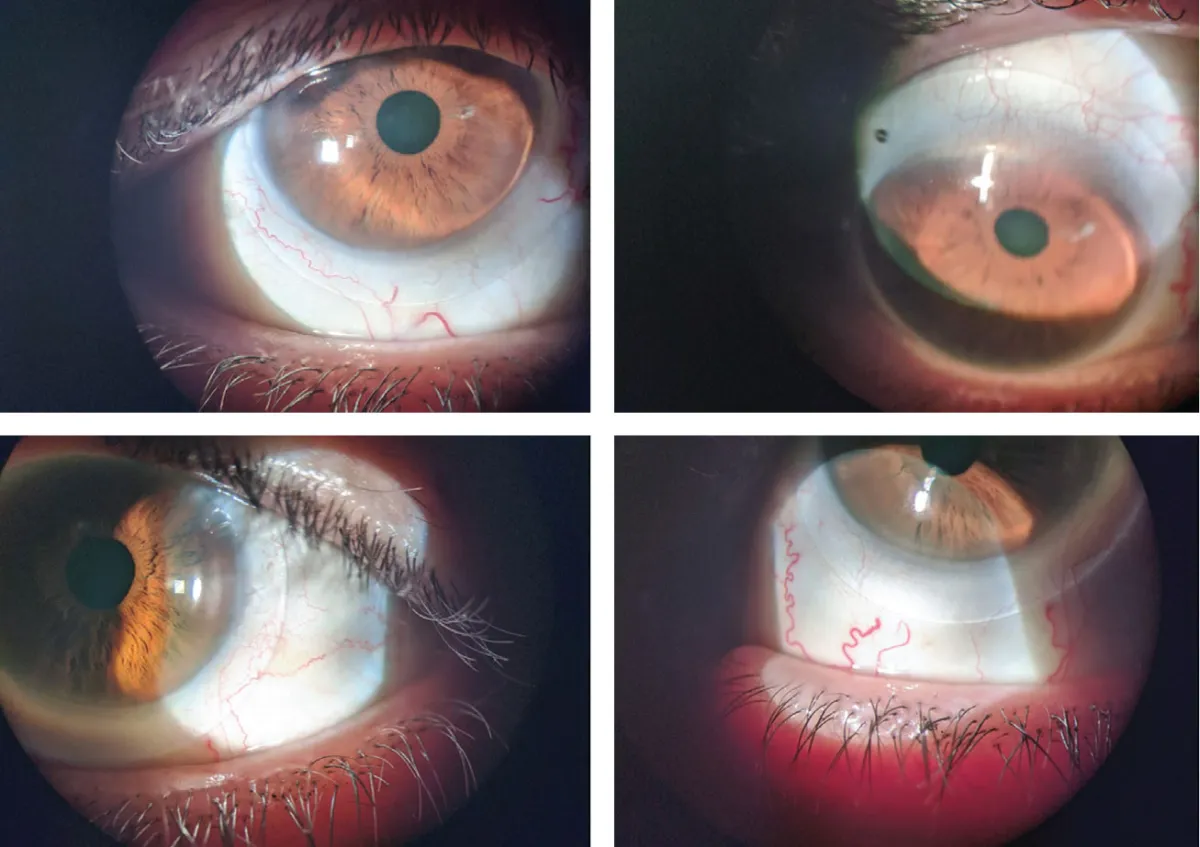 specialty lens options