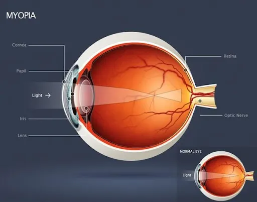 Louetta myopia management