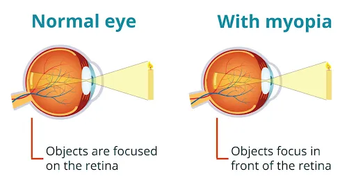 Louetta myopia