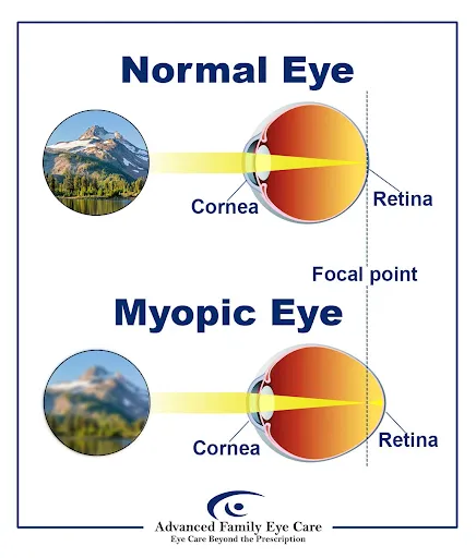 Sheldon myopia management