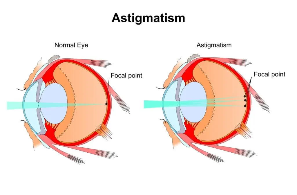 correcting astigmatism