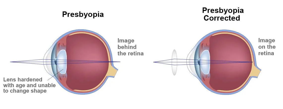 presbyopia symptoms