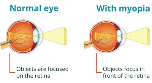 myopia treatment La Porte