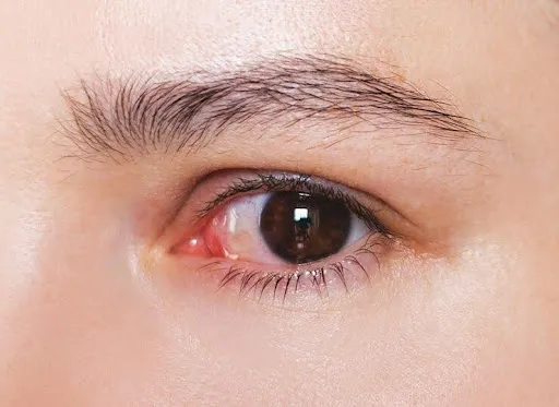 contact lens exam staining