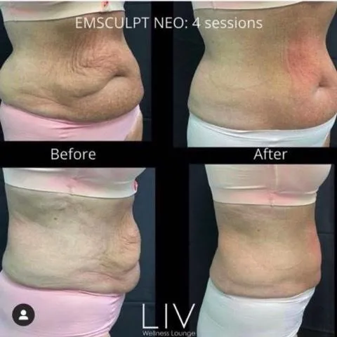 Emsculpt NEO before and after result get rid of belly fat take inches off of stomach. body contouring and body sculpting. Stubborn belly fat. Arm fat. Flabby arms. Cellulite. Flat Butt, pancake butt