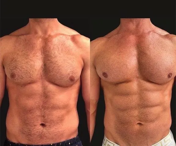 Emsculpt NEO before and after result get rid of belly fat take inches off of stomach. body contouring and body sculpting. Stubborn belly fat. Arm fat. Flabby arms. Cellulite. Flat Butt, pancake butt