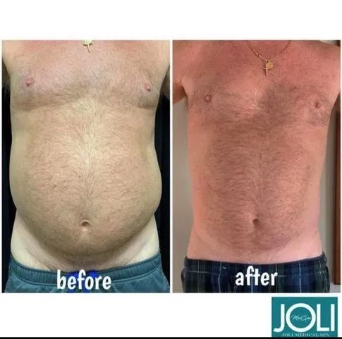 Emsculpt NEO before and after result get rid of belly fat take inches off of stomach. body contouring and body sculpting. Stubborn belly fat. Arm fat. Flabby arms. Cellulite. Flat Butt, pancake butt