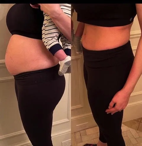 Emsculpt NEO before and after result get rid of belly fat take inches off of stomach. body contouring and body sculpting. Stubborn belly fat. Arm fat. Flabby arms. Cellulite. Flat Butt, pancake butt