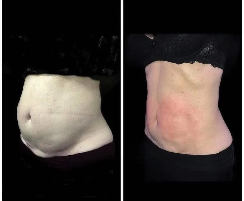 Emsculpt NEO before and after result get rid of belly fat take inches off of stomach. body contouring and body sculpting. Stubborn belly fat. Arm fat. Flabby arms. Cellulite. Flat Butt, pancake butt