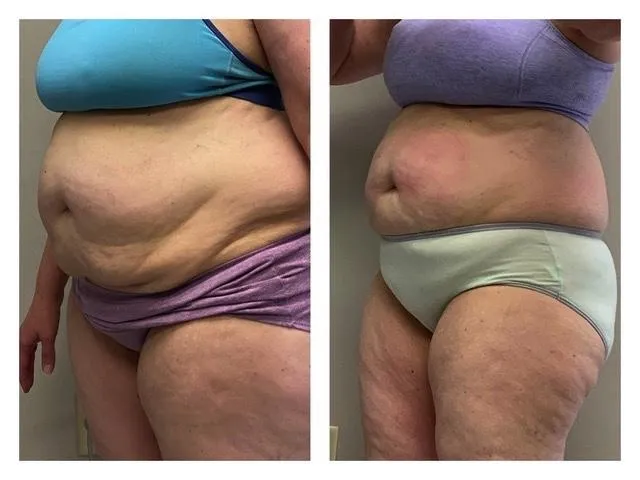 Emsculpt NEO before and after result get rid of belly fat take inches off of stomach. body contouring and body sculpting. Stubborn belly fat. Arm fat. Flabby arms. Cellulite. Flat Butt, pancake butt
