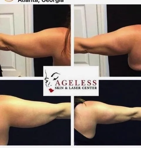 Emsculpt NEO before and after result get rid of belly fat take inches off of stomach. body contouring and body sculpting. Stubborn belly fat. Arm fat. Flabby arms. Cellulite. Flat Butt, pancake butt