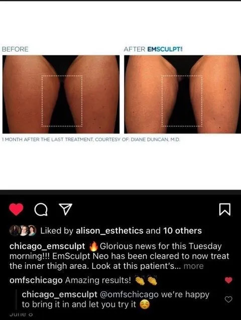 Emsculpt NEO before and after result get rid of belly fat take inches off of stomach. body contouring and body sculpting. Stubborn belly fat. Arm fat. Flabby arms. Cellulite. Flat Butt, pancake butt