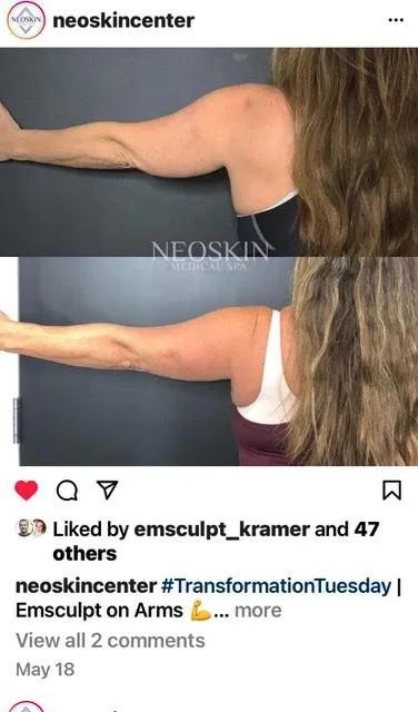 Emsculpt NEO before and after result get rid of belly fat take inches off of stomach. body contouring and body sculpting. Stubborn belly fat. Arm fat. Flabby arms. Cellulite. Flat Butt, pancake butt