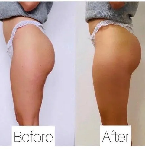 Emsculpt NEO before and after result get rid of belly fat take inches off of stomach. body contouring and body sculpting. Stubborn belly fat. Arm fat. Flabby arms. Cellulite. Flat Butt, pancake butt