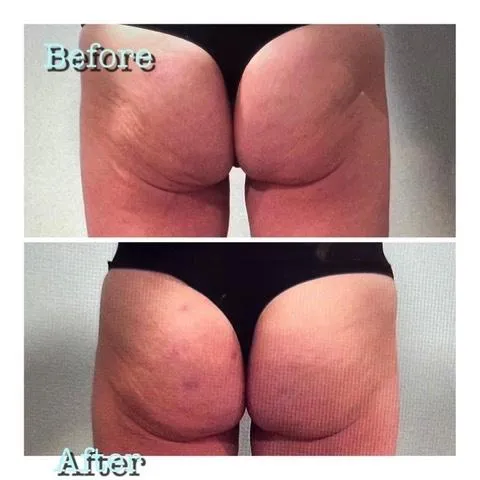 Emsculpt NEO before and after result get rid of belly fat take inches off of stomach. body contouring and body sculpting. Stubborn belly fat. Arm fat. Flabby arms. Cellulite. Flat Butt, pancake butt