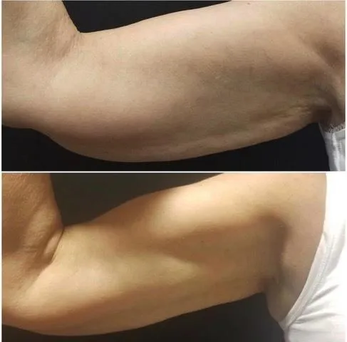 Emsculpt NEO before and after result get rid of belly fat take inches off of stomach. body contouring and body sculpting. Stubborn belly fat. Arm fat. Flabby arms. Cellulite. Flat Butt, pancake butt