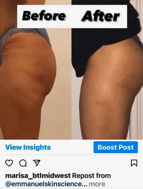 Emsculpt NEO before and after result get rid of belly fat take inches off of stomach. body contouring and body sculpting. Stubborn belly fat. Arm fat. Flabby arms. Cellulite. Flat Butt, pancake butt