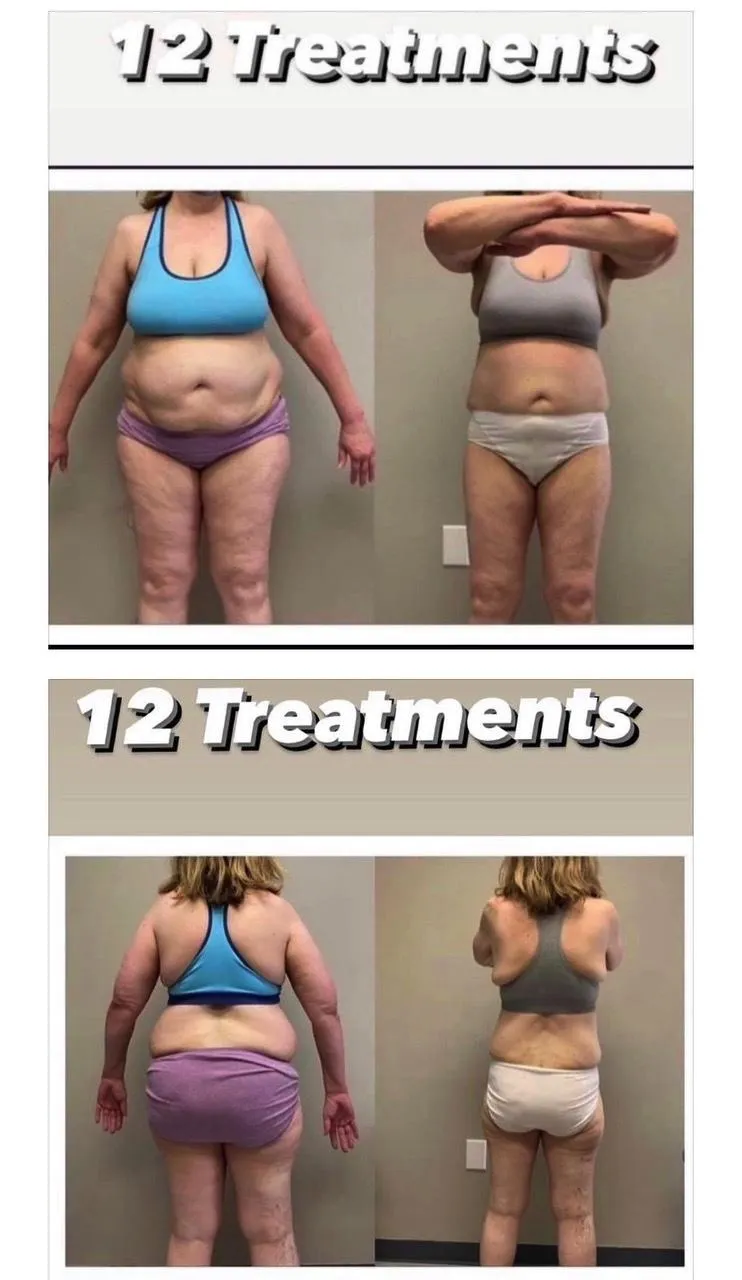 Emsculpt NEO before and after result get rid of belly fat take inches off of stomach. body contouring and body sculpting. Stubborn belly fat. Arm fat. Flabby arms. Cellulite. Flat Butt, pancake butt