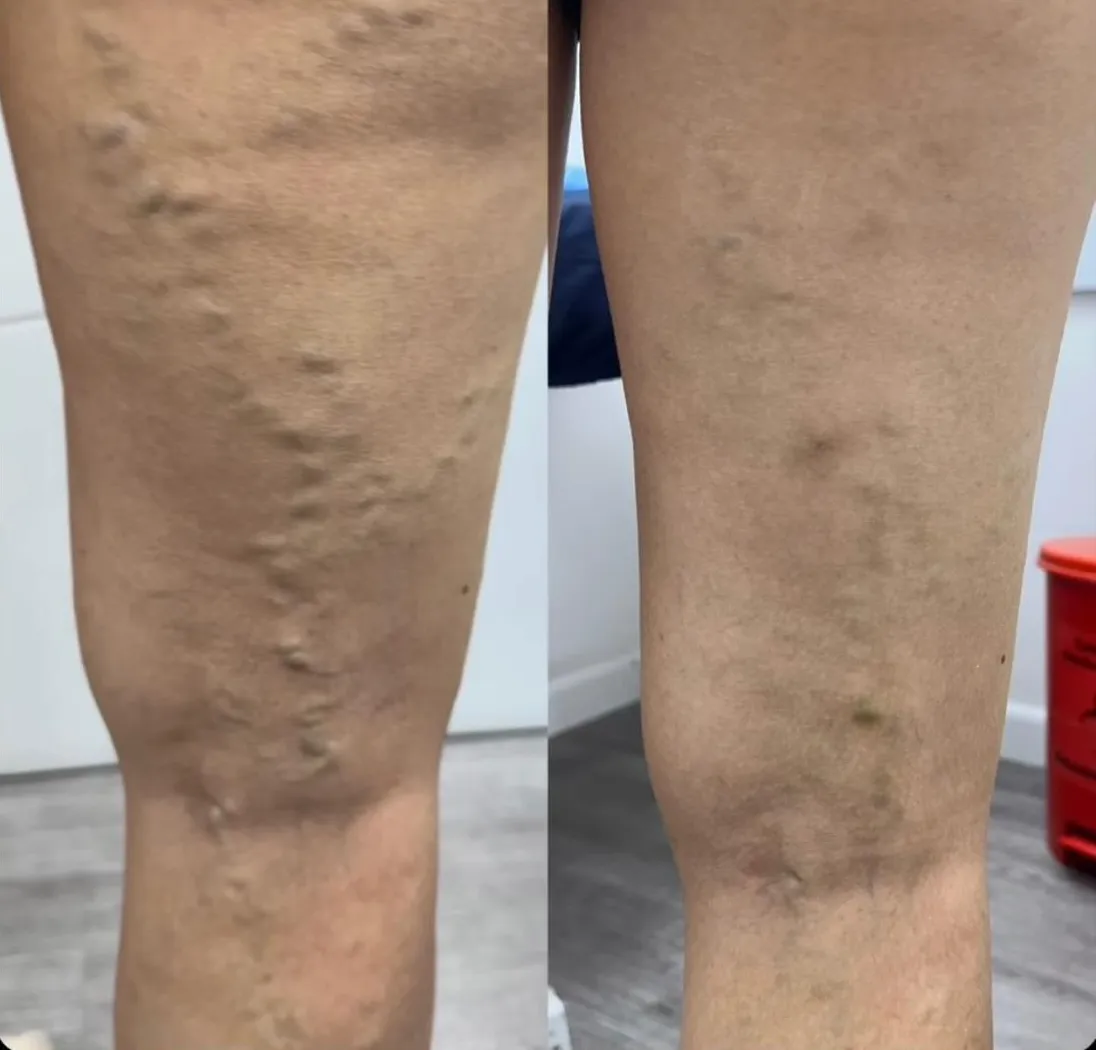 Resultado de paciente - Abdominoplastia
