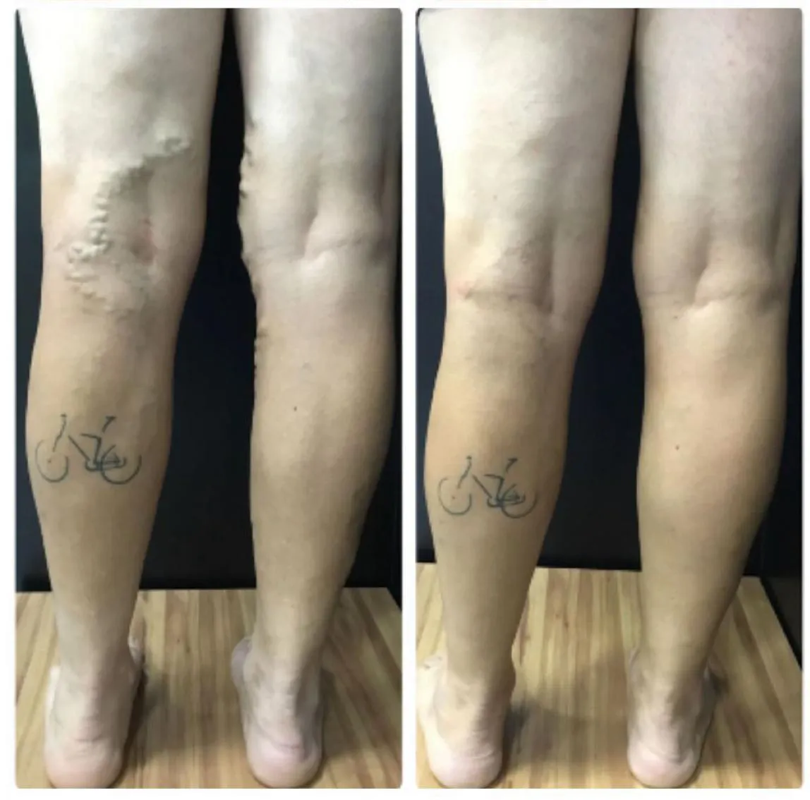 Resultado de paciente - Lipoescultura