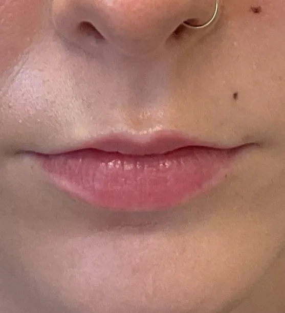 Before lip filler treatment showing natural lips