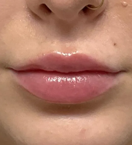 After lip filler treatment with soft, fuller lips