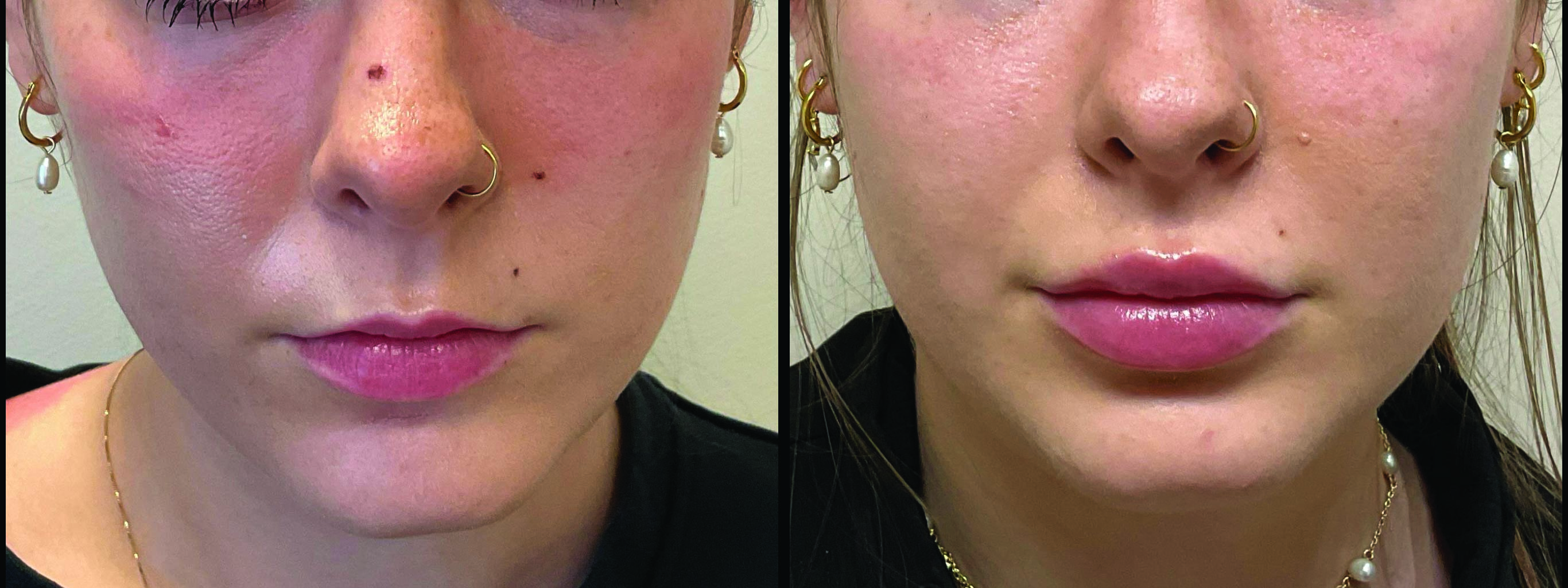 Soft, natural lip enhancement at Allure Medical