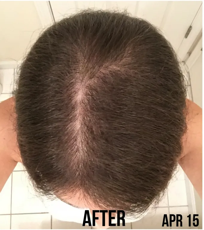After photo showing visibly fuller crown and thicker hairline.
