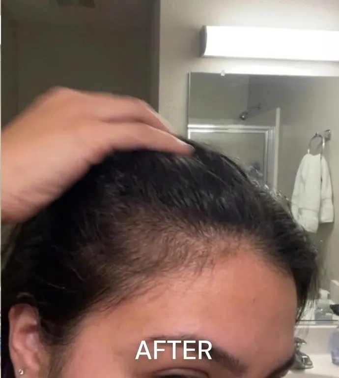 After photo showing new hair growth along the part line.