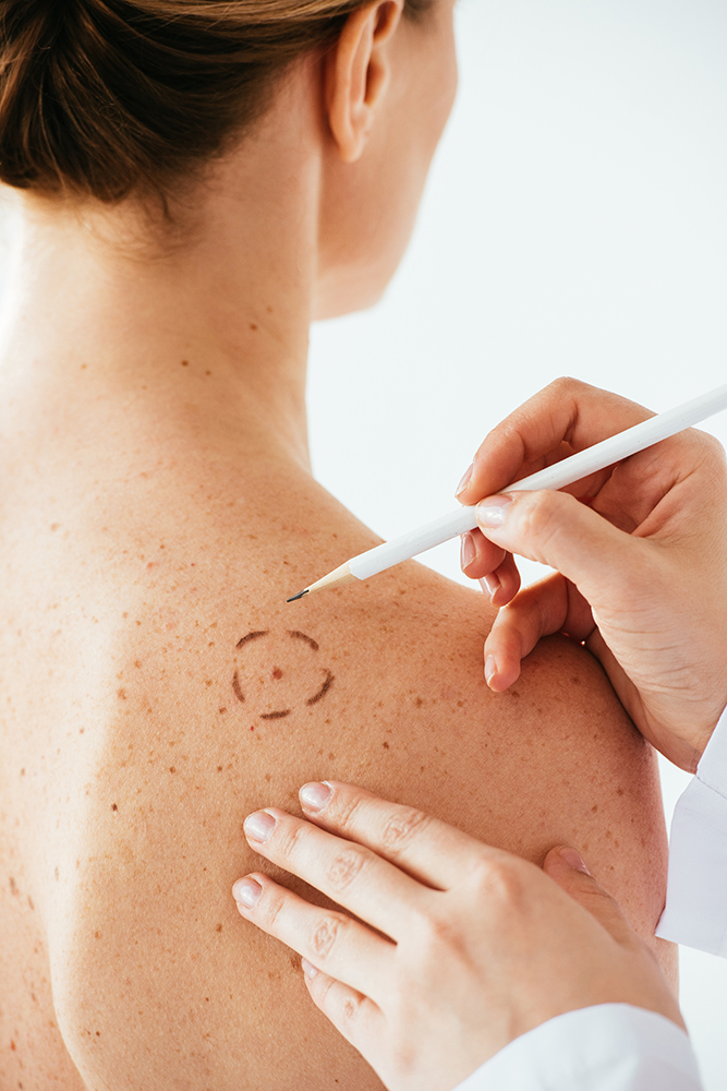 Skin Cancer Treatment