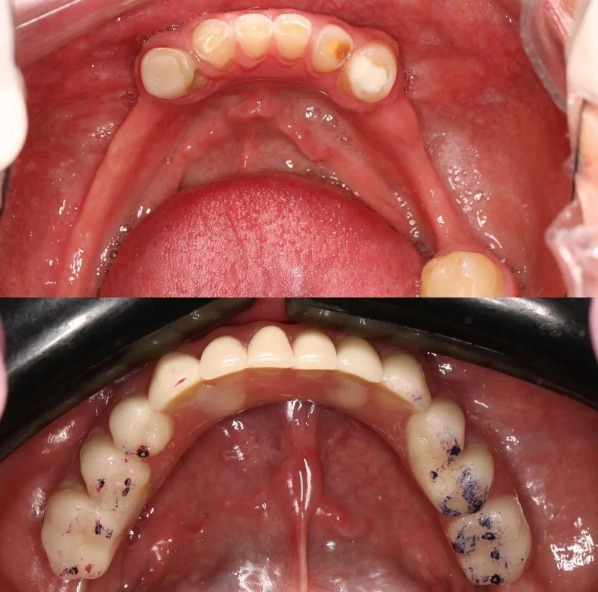 Resultado de paciente - Lipoescultura