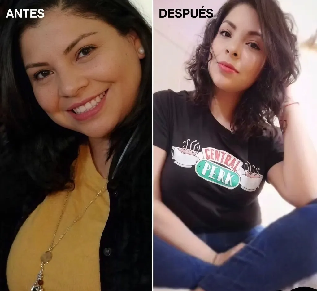 Resultado de paciente - Rinoplastia