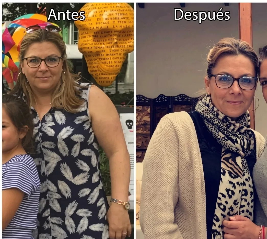 Resultado de paciente - Mamoplastia