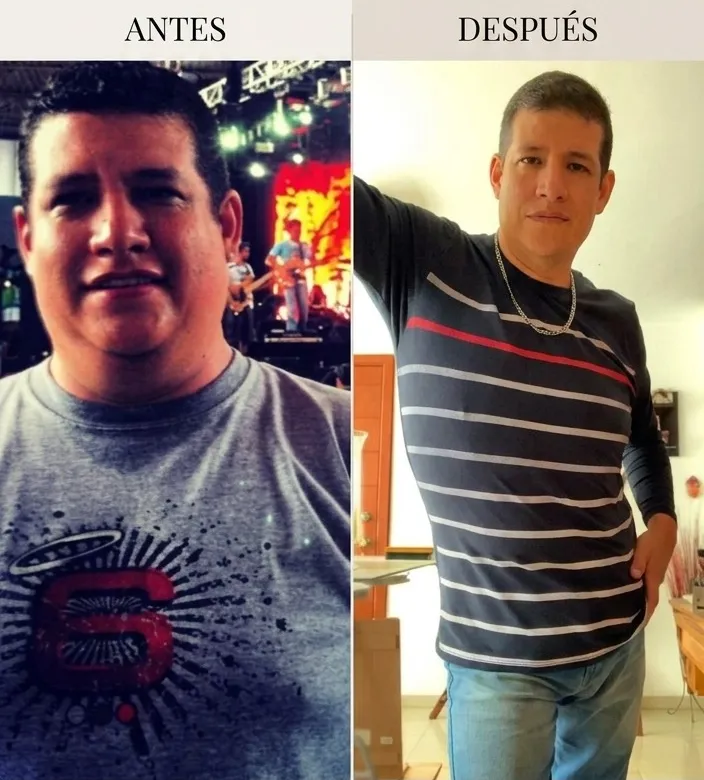 Resultado de paciente - Abdominoplastia