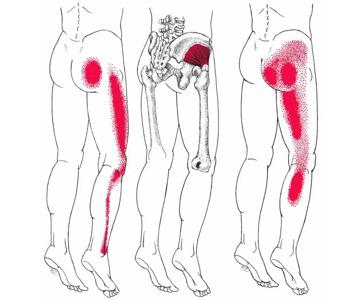 Sciatic Nerve Diagram showing Pain Pathways in Leg and Hips