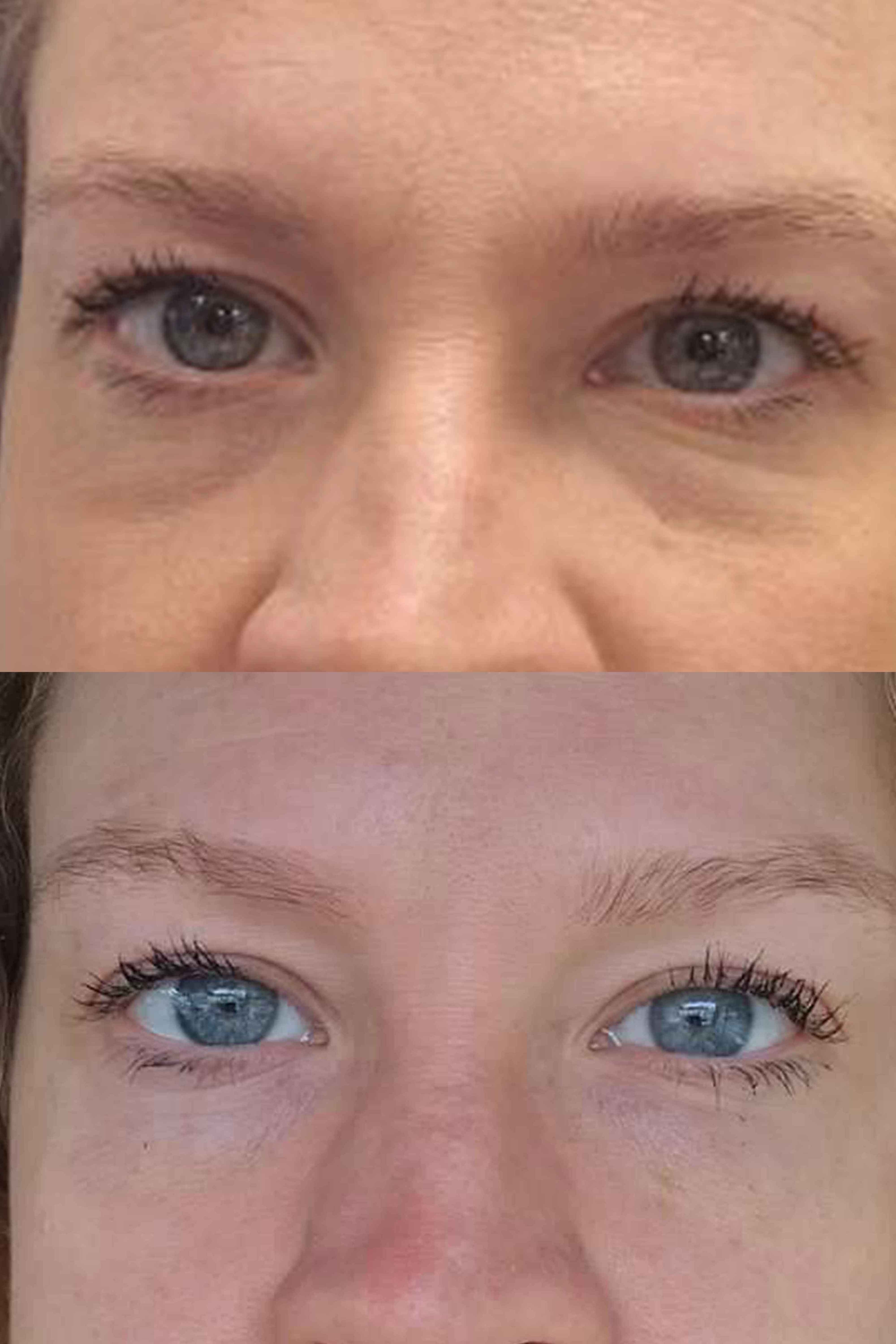 two faces of a woman showing before and after treatments for profhilo