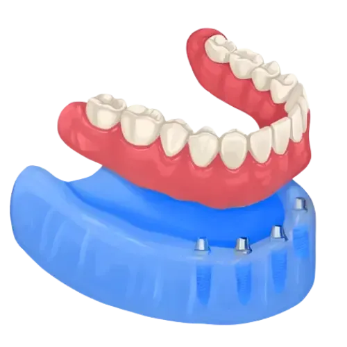 Snap-On Dentures