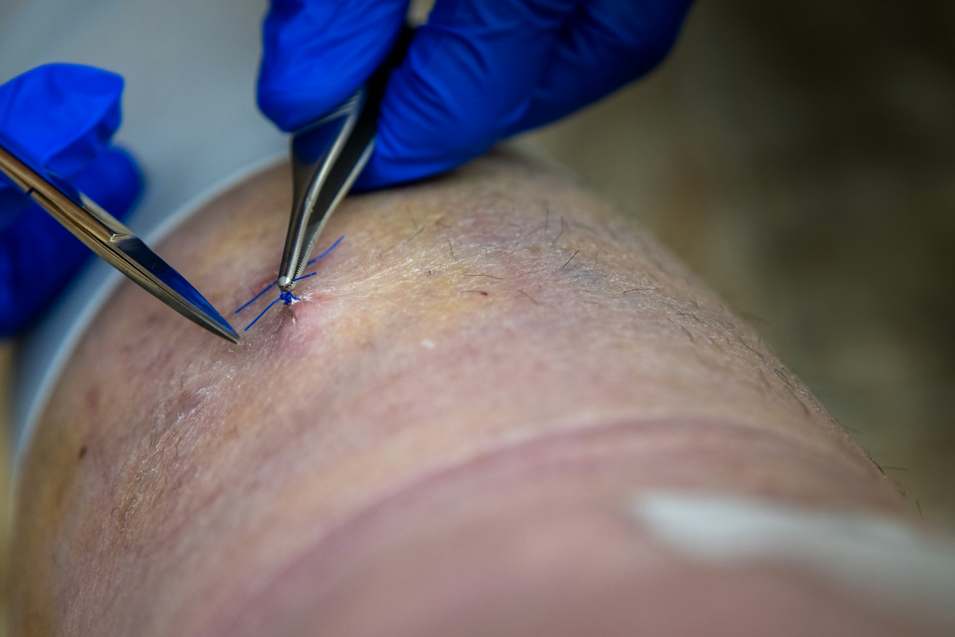 Comparing Vein Removal Procedures Without Getting Overwhelmed